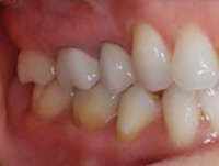 Periodontitis disease